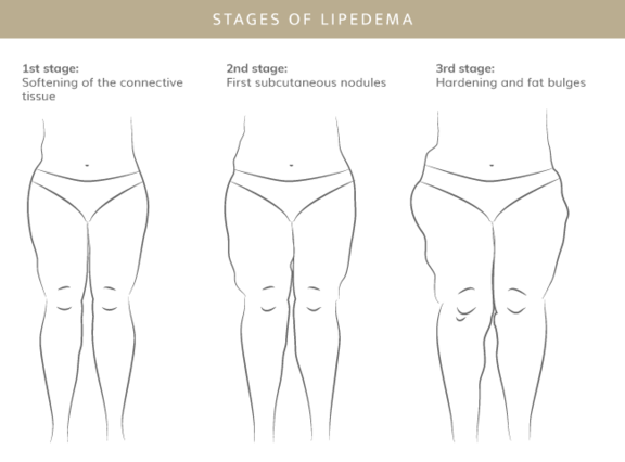 Stadien Lipödem, Plastische & Ästhetische Chirurgie in Stuttgart, Dr. Schumacher