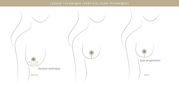 Bruststraffung Lejour-Methode, Plastische & Ästhetische Chirurgie in Stuttgart, Dr. Schumacher
