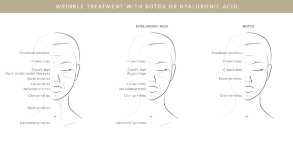 Faltenbehandlung mit Botox oder Hyaluron, Plastische & Ästhetische Chirurgie in Stuttgart, Dr. Schumacher