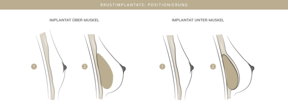 Brustimplantate, Plastische & Ästhetische Chirurgie in Stuttgart, Dr. Schumacher