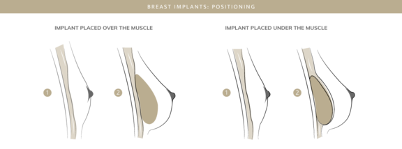 Brustimplantate, Plastische & Ästhetische Chirurgie in Stuttgart, Dr. Schumacher