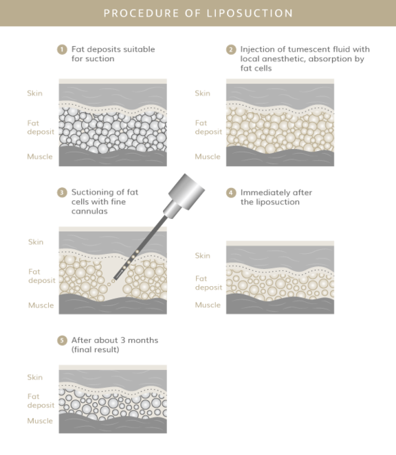 Ablauf Fettabsaugung, Plastische & Ästhetische Chirurgie in Stuttgart, Dr. Schumacher
