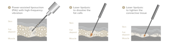 Lipödem OP, Plastische & Ästhetische Chirurgie in Stuttgart, Dr. Schumacher