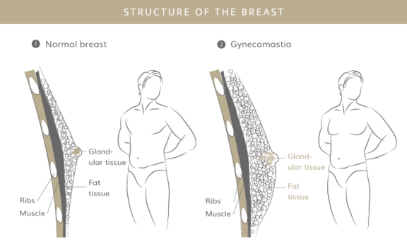 Gynäkomastie OP, Plastische & Ästhetische Chirurgie in Stuttgart, Dr. Schumacher