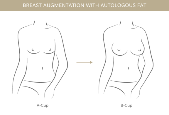 Brustvergrößerung mit Eigenfett, Plastische & Ästhetische Chirurgie in Stuttgart, Dr. Schumacher