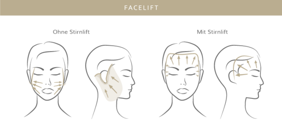 Facelift, Plastische & Ästhetische Chirurgie in Stuttgart, Dr. Schumacher