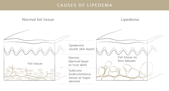 Ursachen Lipödem, Plastische & Ästhetische Chirurgie in Stuttgart, Dr. Schumacher