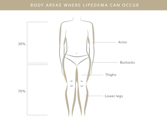 Körperstellen Lipödem, Plastische & Ästhetische Chirurgie in Stuttgart, Dr. Schumacher