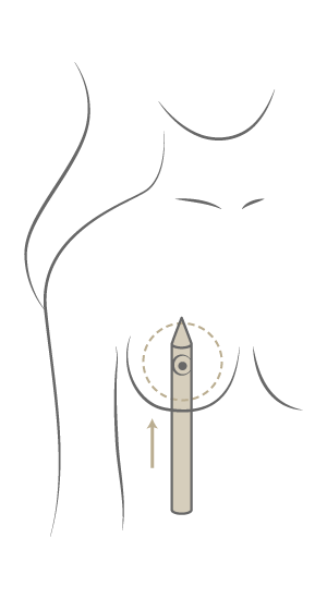 Brustvergrößerung Motiva Preservé™, Plastische & Ästhetische Chirurgie in Stuttgart, Dr. Schumacher