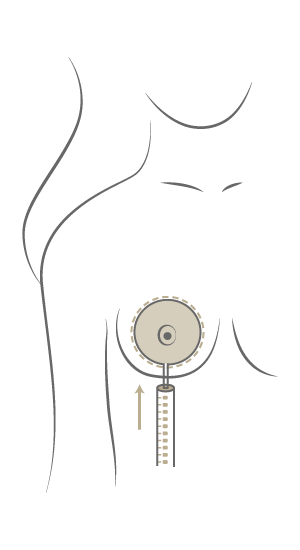 Brustvergrößerung Motiva Preservé™, Plastische & Ästhetische Chirurgie in Stuttgart, Dr. Schumacher