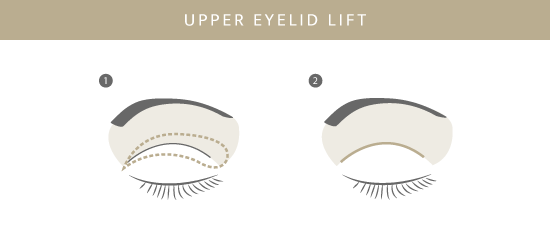 Oberlidstraffung, Plastische & Ästhetische Chirurgie in Stuttgart, Dr. Schumacher