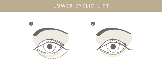 Unterlidstraffung, Plastische & Ästhetische Chirurgie in Stuttgart, Dr. Schumacher